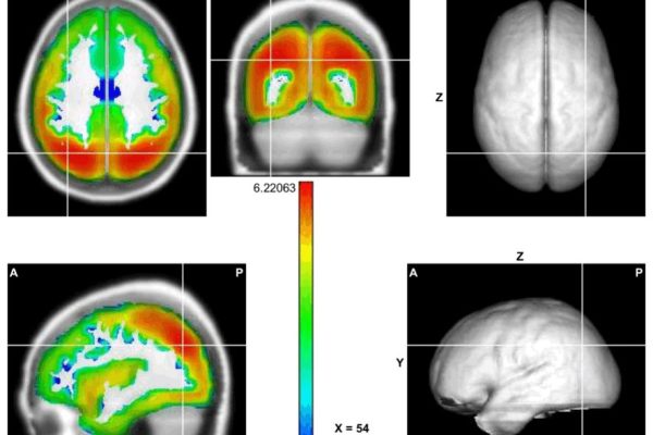 Low Resolution Electric Tomography (LORETA)