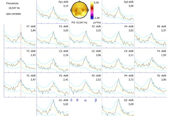 Quantitative Electroencephalogram (qEEG)